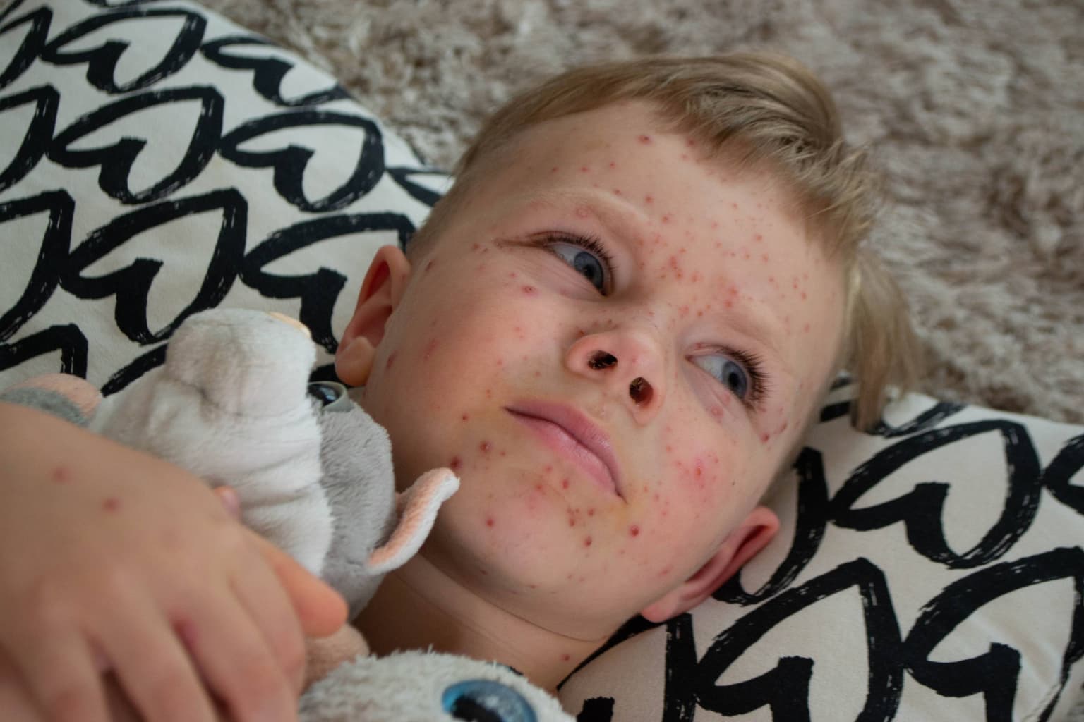 Rujeola: Cea mai contagioasă boală virală. Simptome și complicații