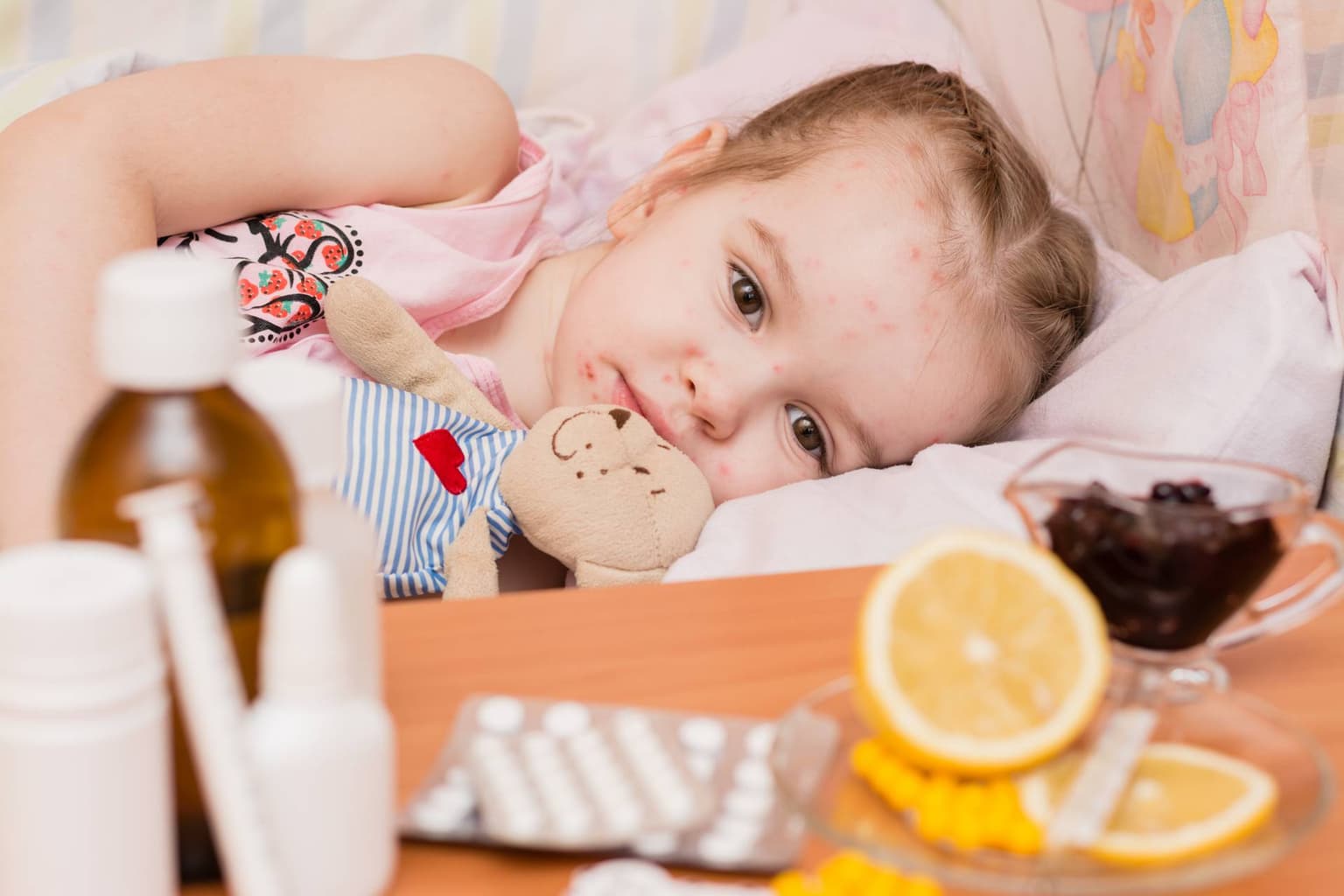 Varicela: Cauze, simptome, trasmitere, tratament si prevenire