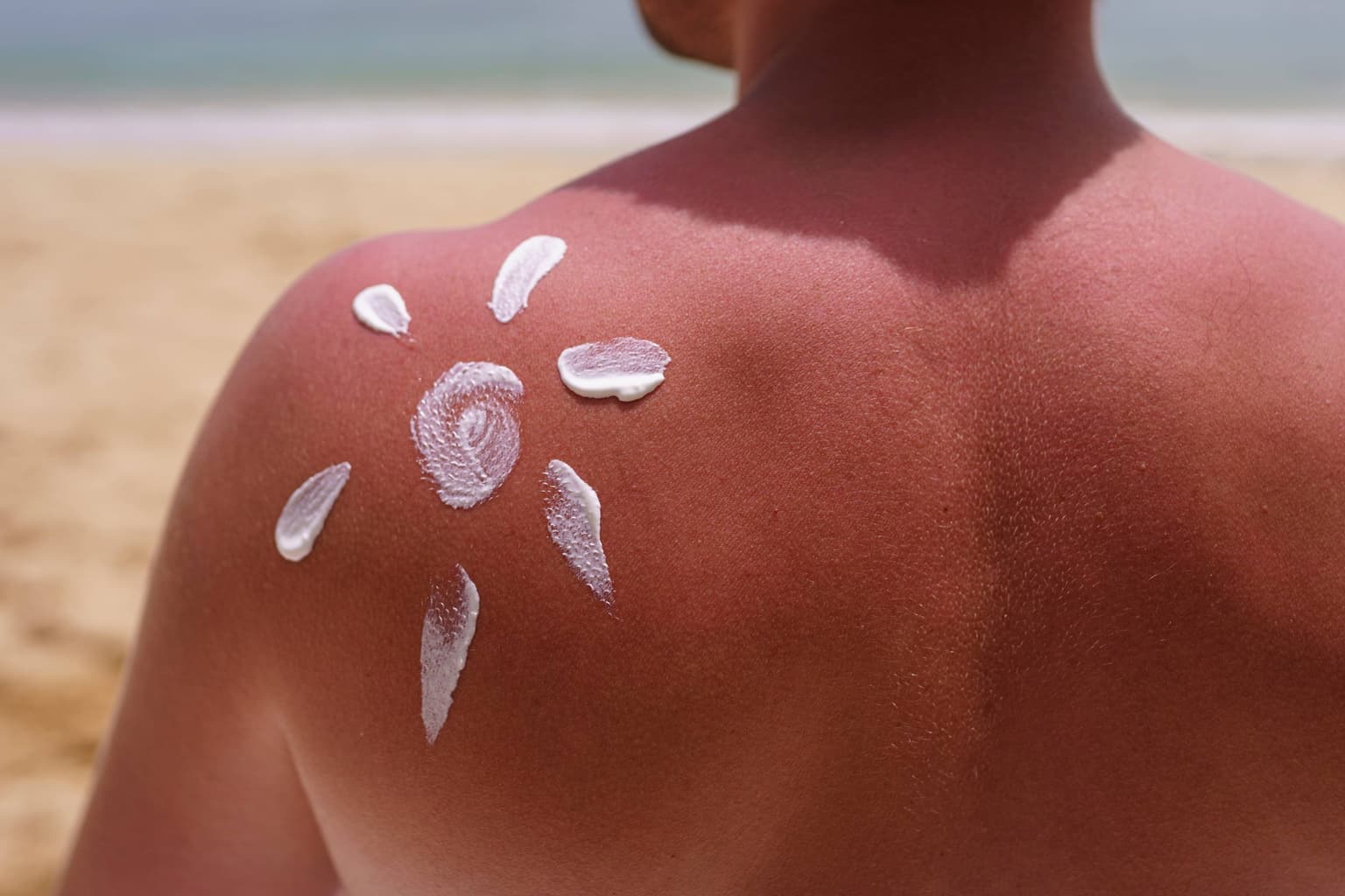 Tot ce trebuie să știi despre arsurile solare: simptome, tratament și prevenție