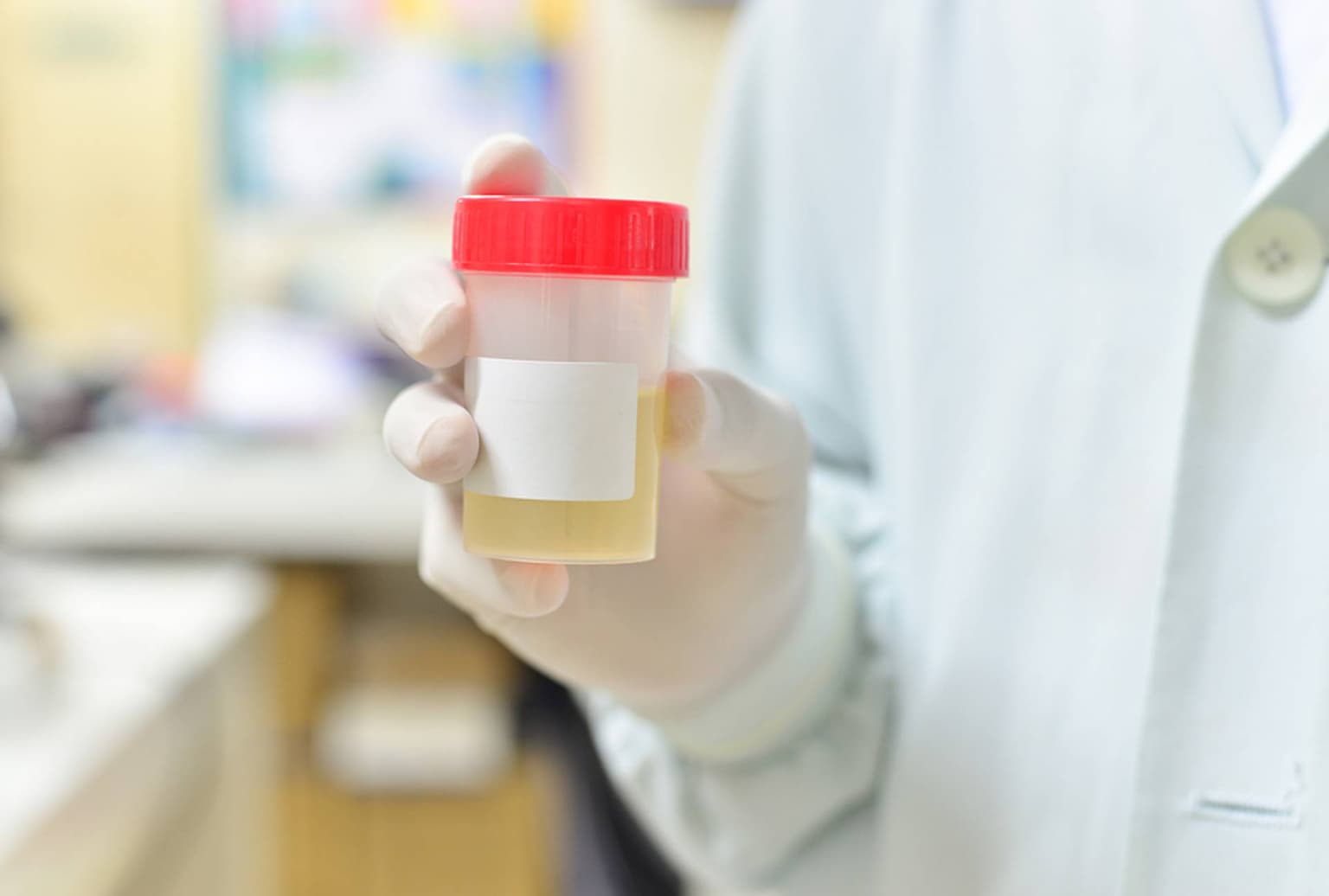 Examen complet de urină (sumar și sediment urinar): ghid actualizat pentru pacienți