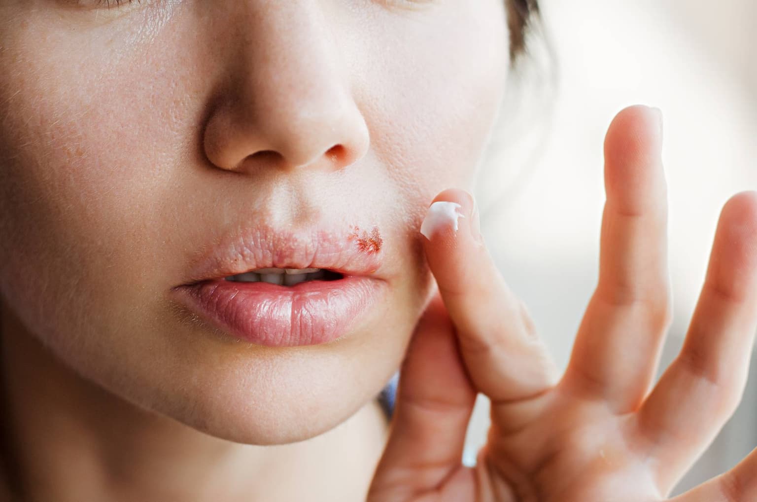 Herpes oral: simptome, cauze, tratament