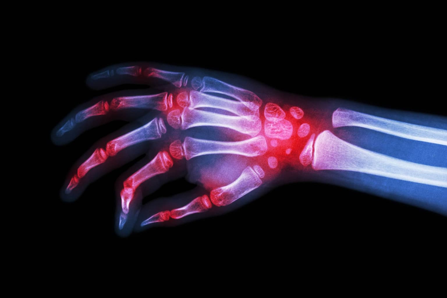 Reumatismul articular acut (RAA): cauze, simptome și diagnostic
