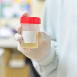 Examen complet de urină (sumar și sediment urinar): ghid actualizat pentru pacienți