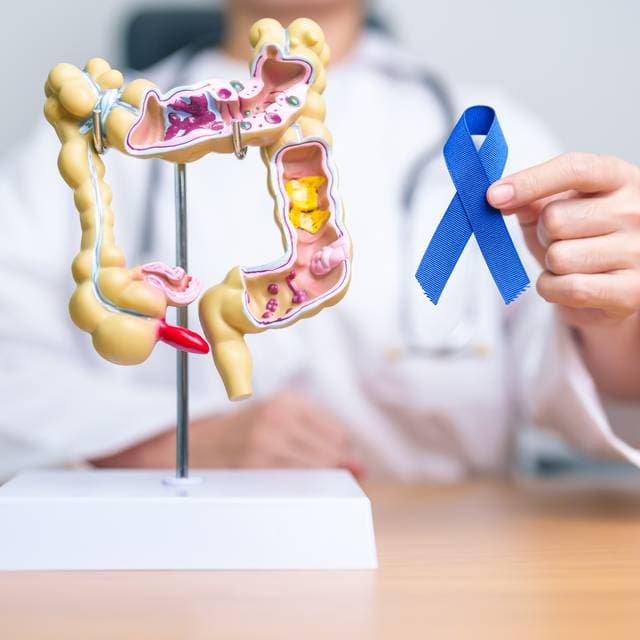 Cancer de colon: simptome, diagnostic, tratament