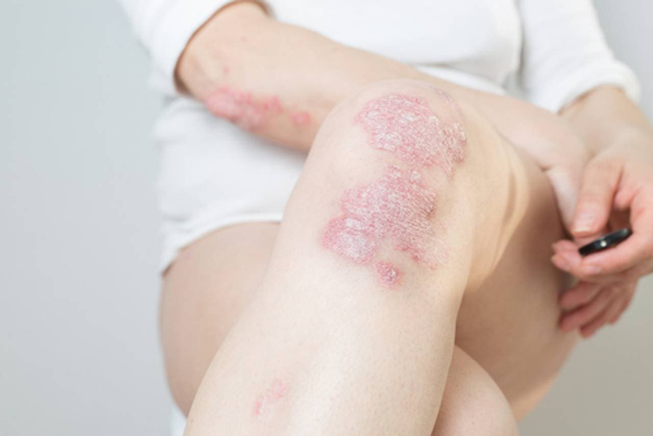 Psoriazis: cauze, tipuri, simptome, implicatii psiho-sociale, tratament |  Bioclinica