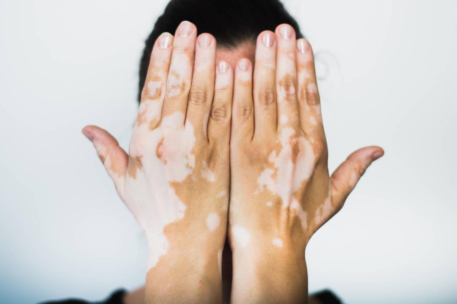 Vitiligo – cine este afectat și de ce?