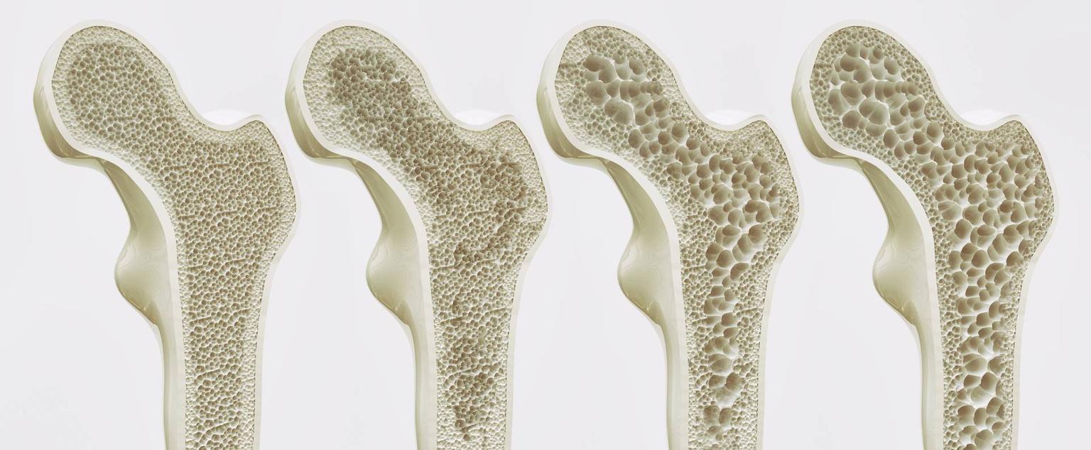 Osteoporoza, boala oaselor fragile: Simptome, tratament, dietă