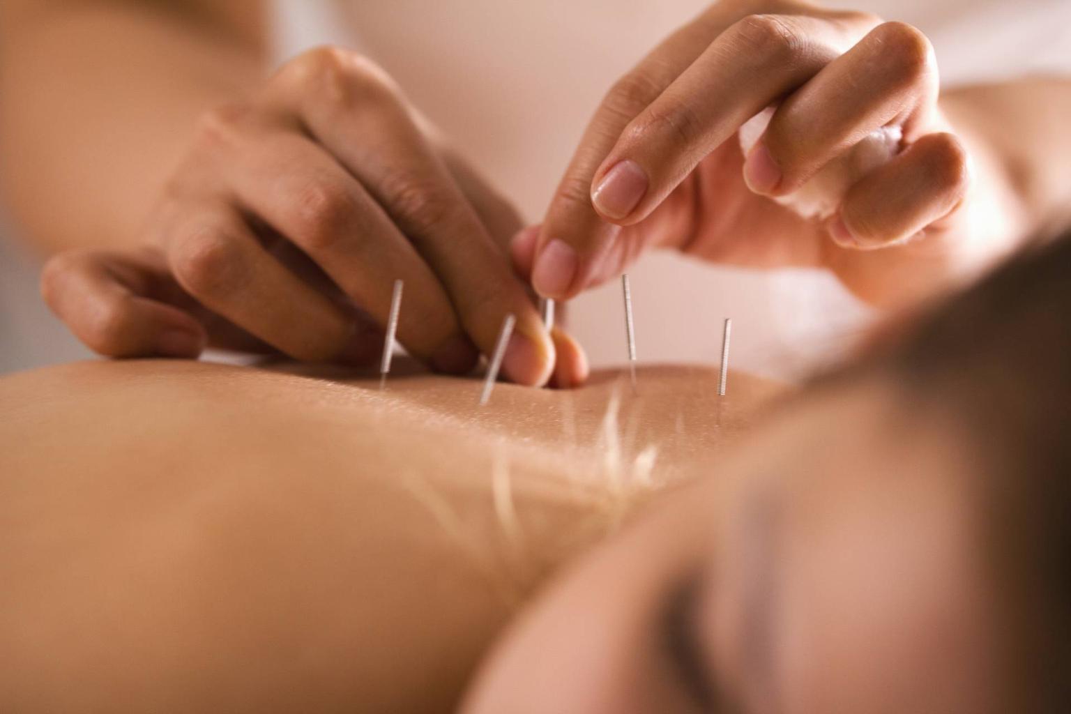 Cum ne poate ajuta acupunctura?