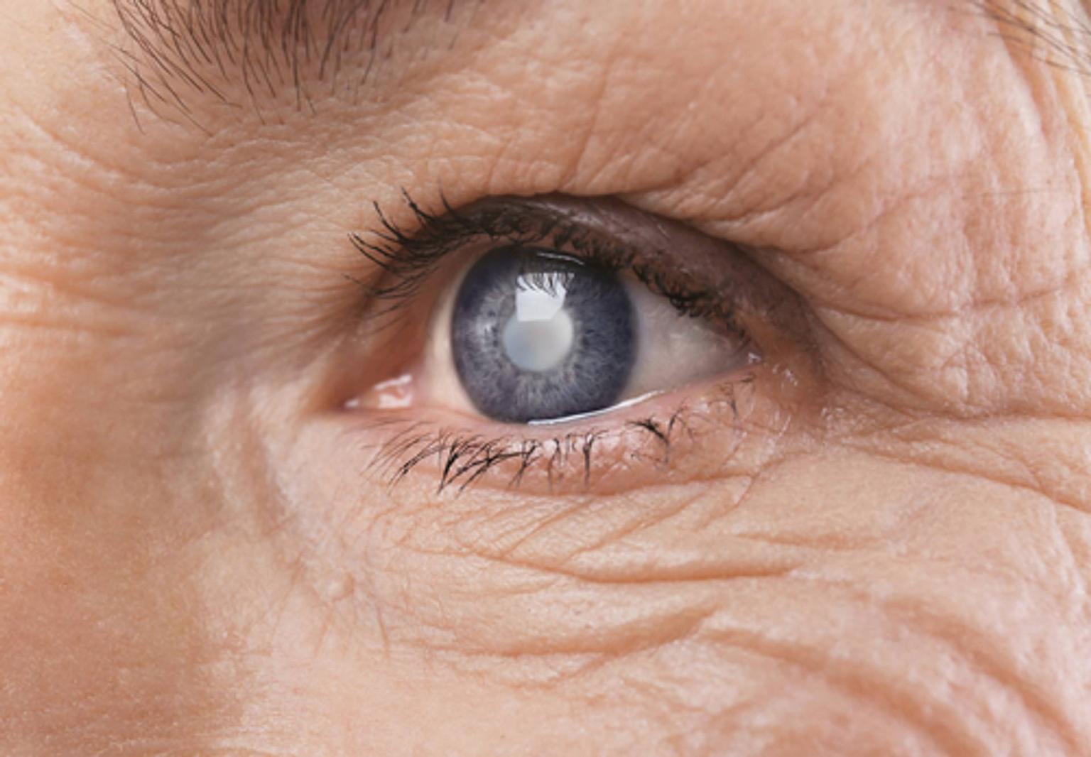 Cataracta: generalități, simptome, cauze, diagnostic, tratament