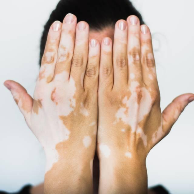 Vitiligo – cine este afectat și de ce?