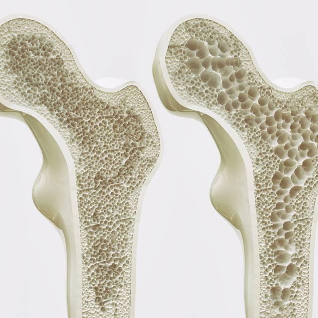 Osteoporoza, boala oaselor fragile: Simptome, tratament, dietă
