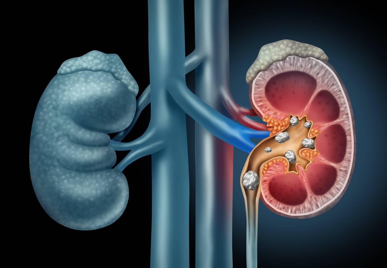 Ce trebuie sa stii despre pietrele la rinichi (calculi renali) | Bioclinica